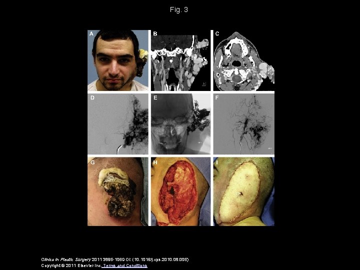 Fig. 3 Clinics in Plastic Surgery 2011 3895 -106 DOI: (10. 1016/j. cps. 2010.