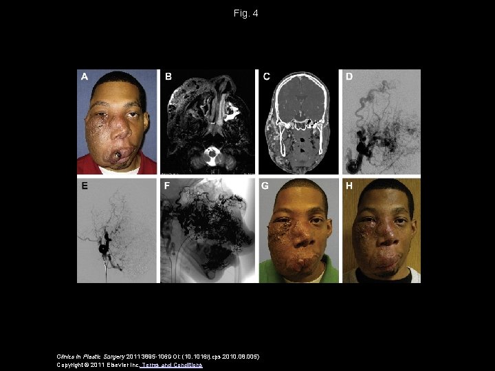 Fig. 4 Clinics in Plastic Surgery 2011 3895 -106 DOI: (10. 1016/j. cps. 2010.