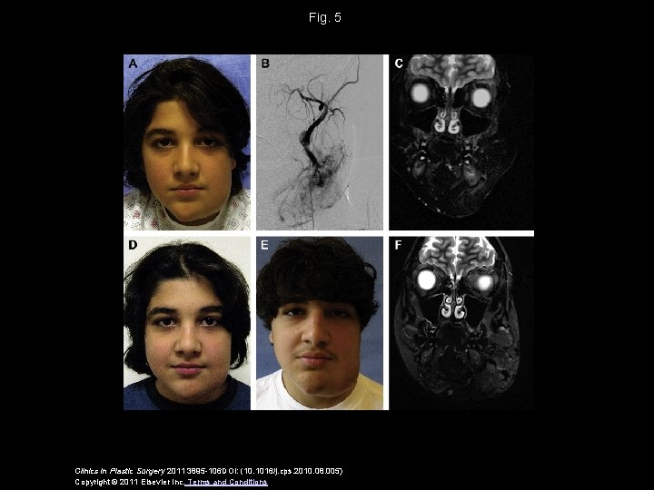 Fig. 5 Clinics in Plastic Surgery 2011 3895 -106 DOI: (10. 1016/j. cps. 2010.