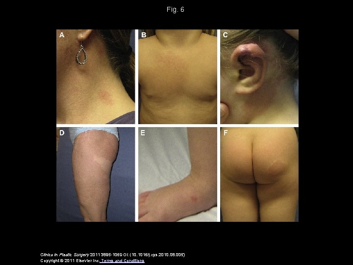 Fig. 6 Clinics in Plastic Surgery 2011 3895 -106 DOI: (10. 1016/j. cps. 2010.