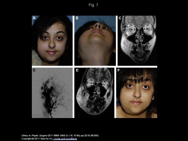 Fig. 7 Clinics in Plastic Surgery 2011 3895 -106 DOI: (10. 1016/j. cps. 2010.