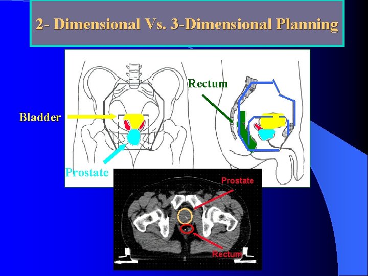 2 - Dimensional Vs. 3 -Dimensional Planning Rectum Bladder Prostate Rectum 