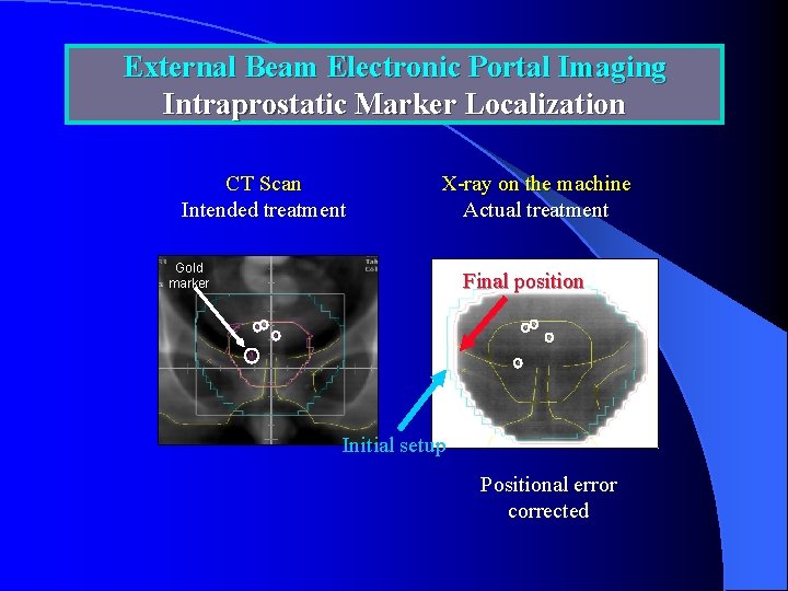 External Beam Electronic Portal Imaging Intraprostatic Marker Localization CT Scan Intended treatment X-ray on