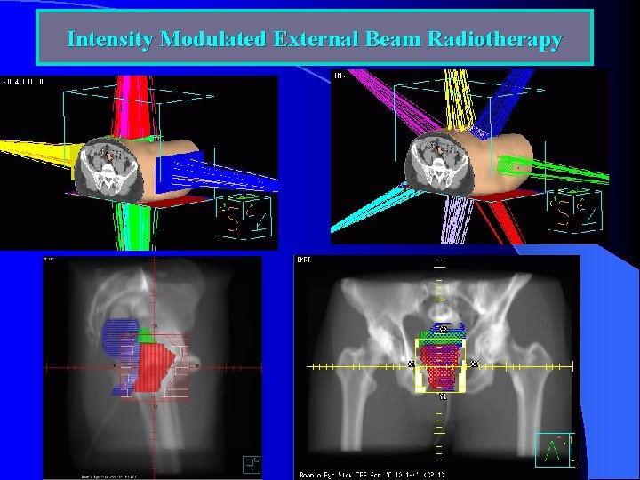 Intensity Modulated External Beam Radiotherapy 