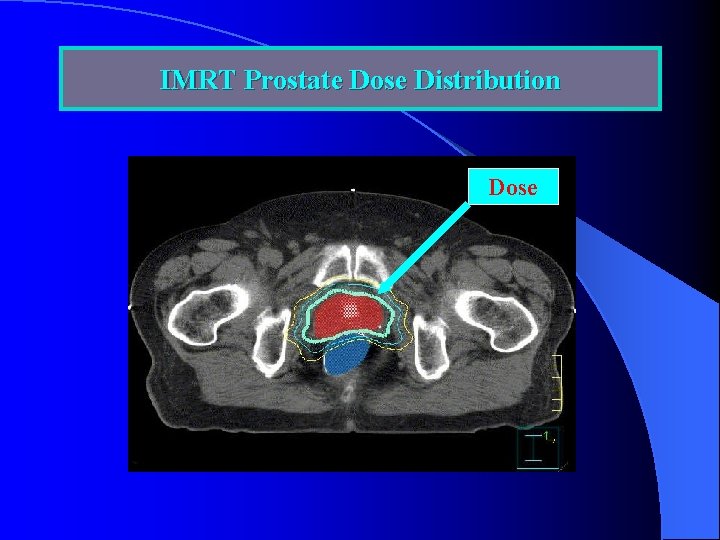 IMRT Prostate Dose Distribution Dose 