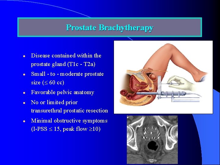 Prostate Brachytherapy l l l Disease contained within the prostate gland (T 1 c
