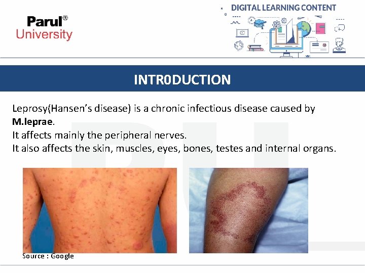 INTR 0 DUCTION Leprosy(Hansen’s disease) is a chronic infectious disease caused by M. leprae.