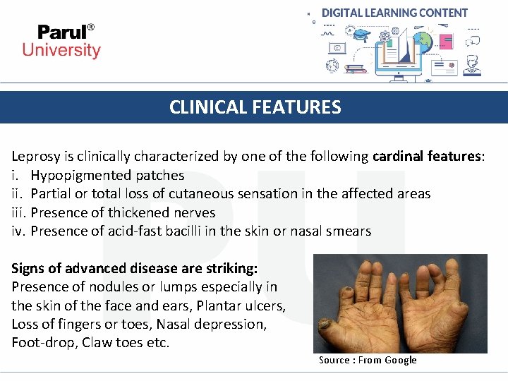 CLINICAL FEATURES Leprosy is clinically characterized by one of the following cardinal features: i.