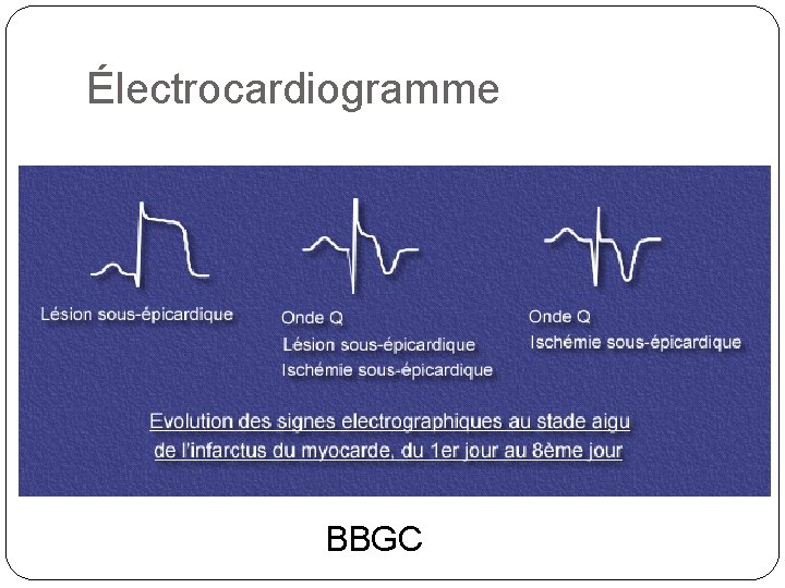 Électrocardiogramme BBGC 