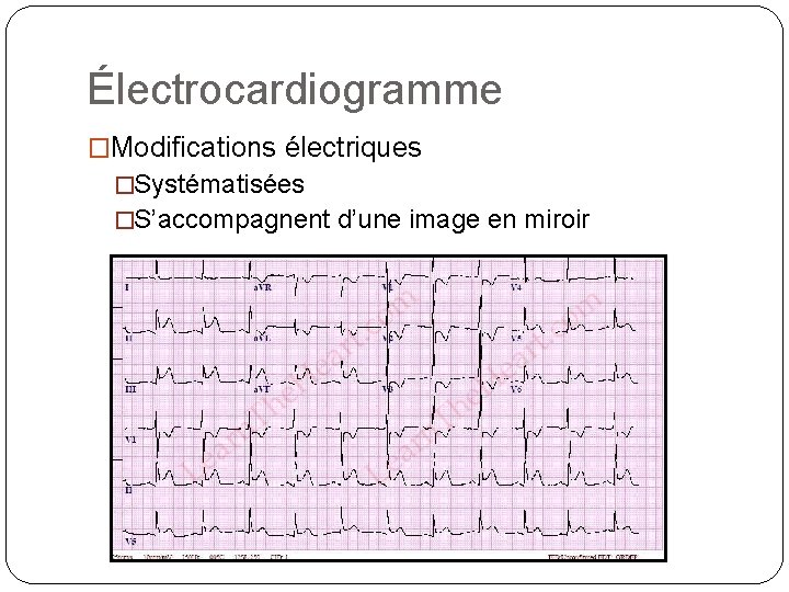 Électrocardiogramme �Modifications électriques �Systématisées �S’accompagnent d’une image en miroir 