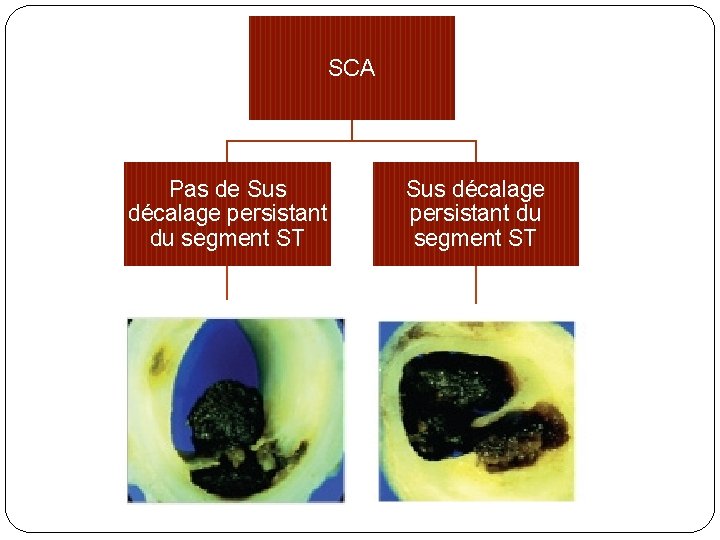 SCA Pas de Sus décalage persistant du segment ST Pas d’occlusion artérielle Occlusion artérielle
