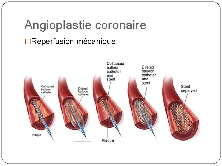 Angioplastie coronaire �Reperfusion mécanique 