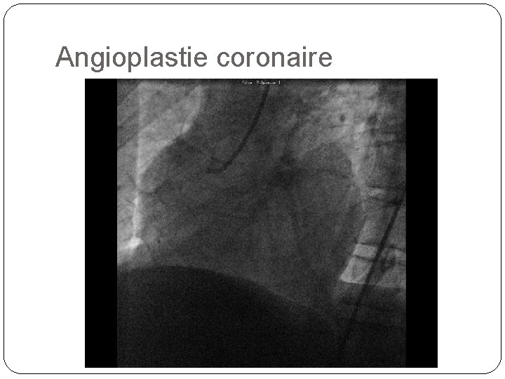 Angioplastie coronaire 