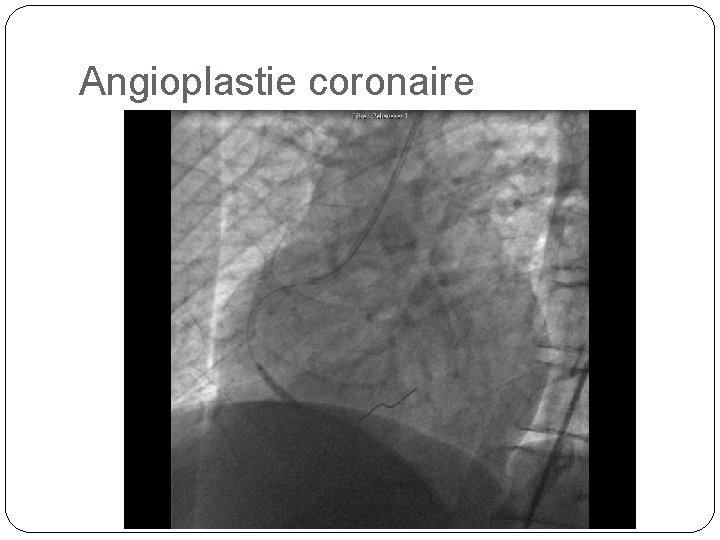 Angioplastie coronaire 