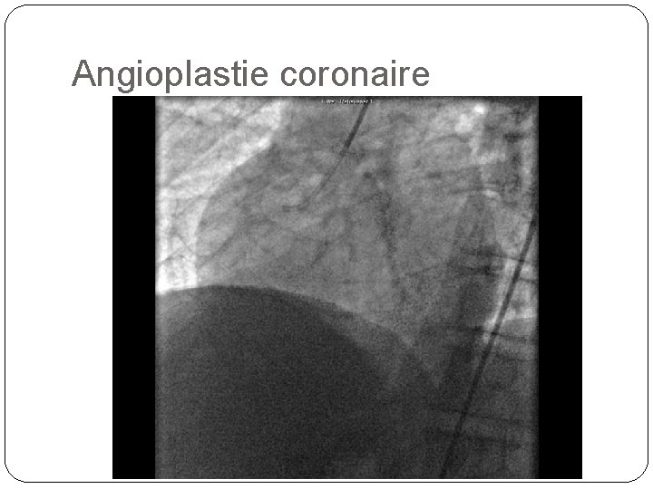 Angioplastie coronaire 