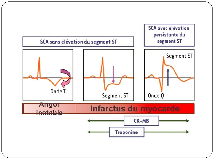 Angor instable Infarctus du myocarde 