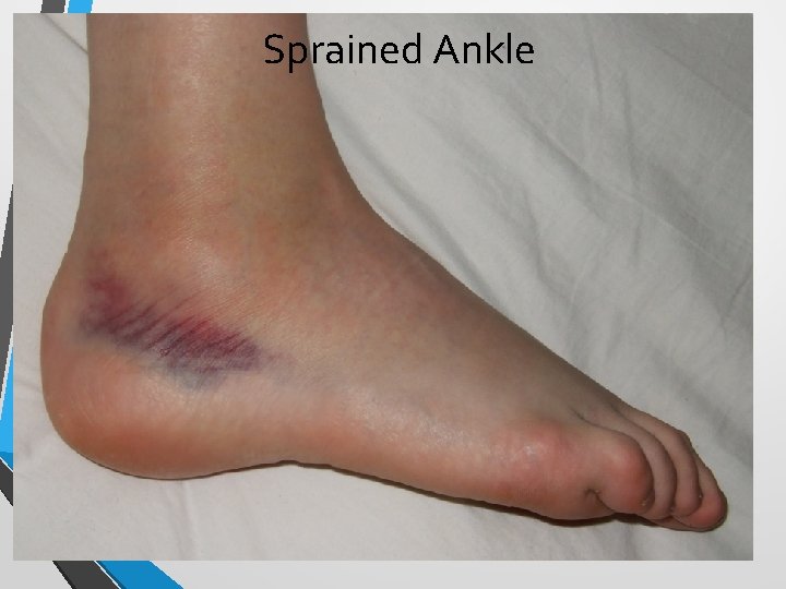 Sprained Ankle 