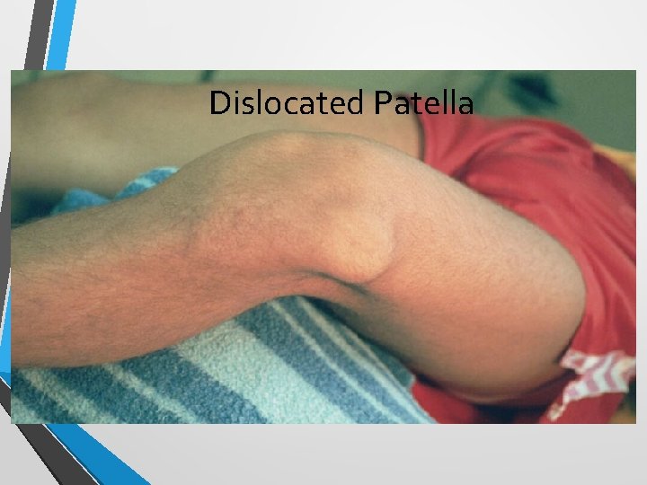 Dislocated Patella 