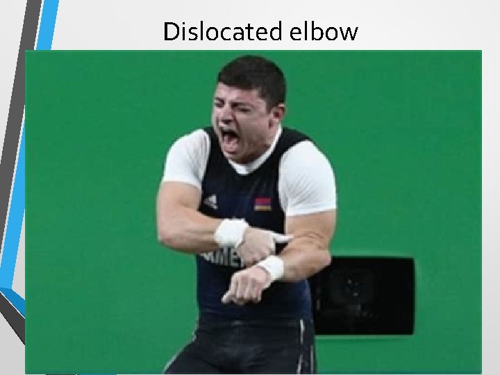 Dislocated elbow 