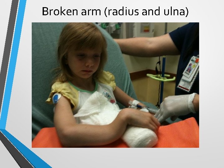 Broken arm (radius and ulna) 