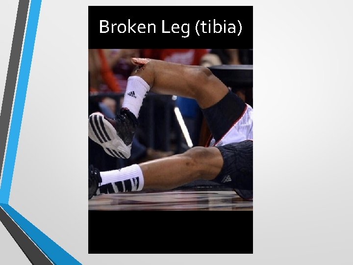 Broken Leg (tibia) 