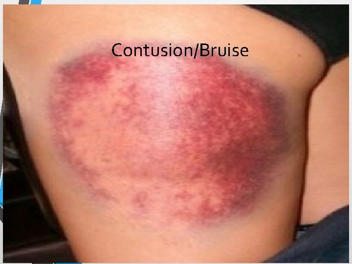 Contusion/Bruise 