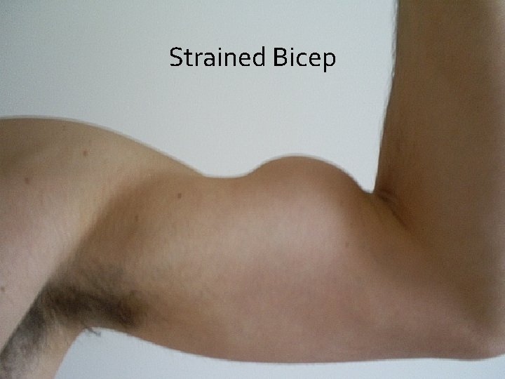 Strained Bicep 