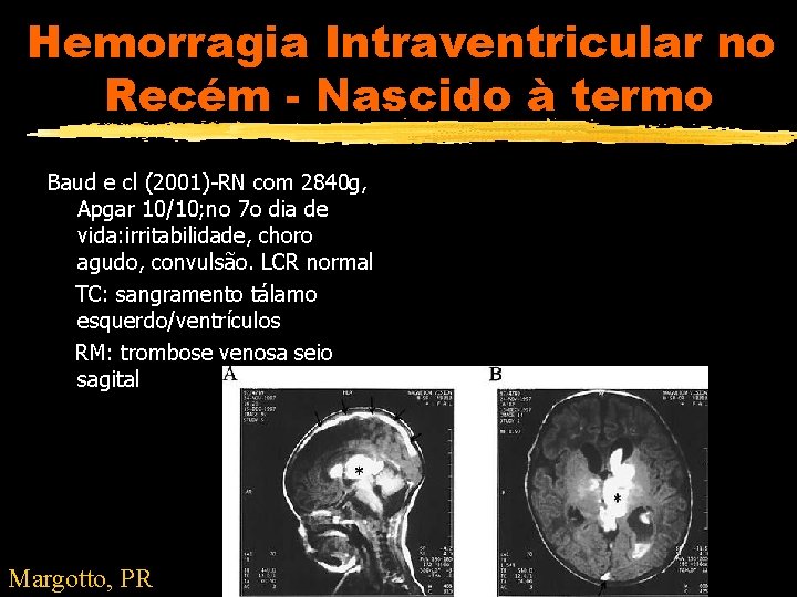 Hemorragia Intraventricular no Recém - Nascido à termo Baud e cl (2001)-RN com 2840