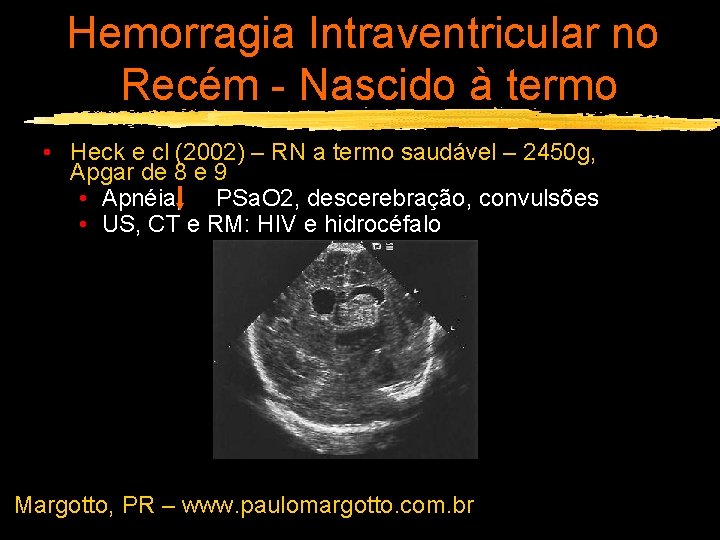 Hemorragia Intraventricular no Recém - Nascido à termo • Heck e cl (2002) –