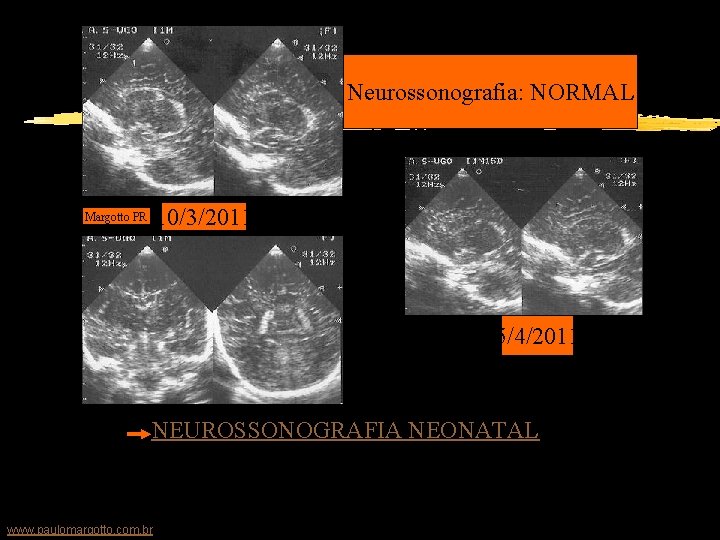 Neurossonografia: NORMAL Margotto PR 10/3/2011 5/4/2011 Clicar aqui!NEUROSSONOGRAFIA NEONATAL Paulo R. Margotto (consulte hemorragias