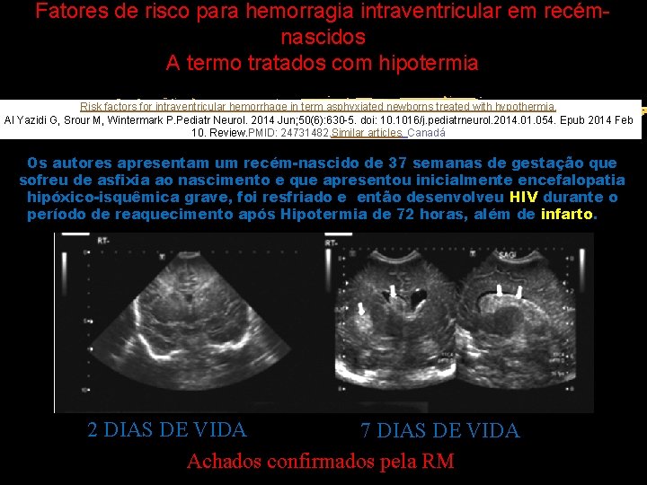 Fatores de risco para hemorragia intraventricular em recémnascidos A termo tratados com hipotermia Risk