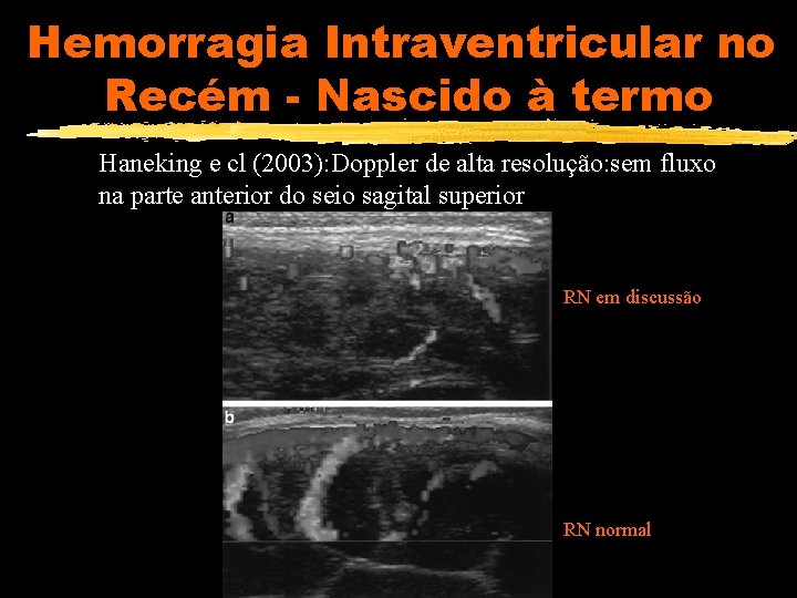 Hemorragia Intraventricular no Recém - Nascido à termo Haneking e cl (2003): Doppler de