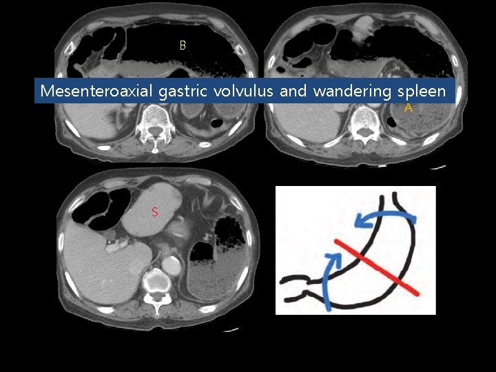 B P Mesenteroaxial gastric volvulus and wandering spleen A A S 