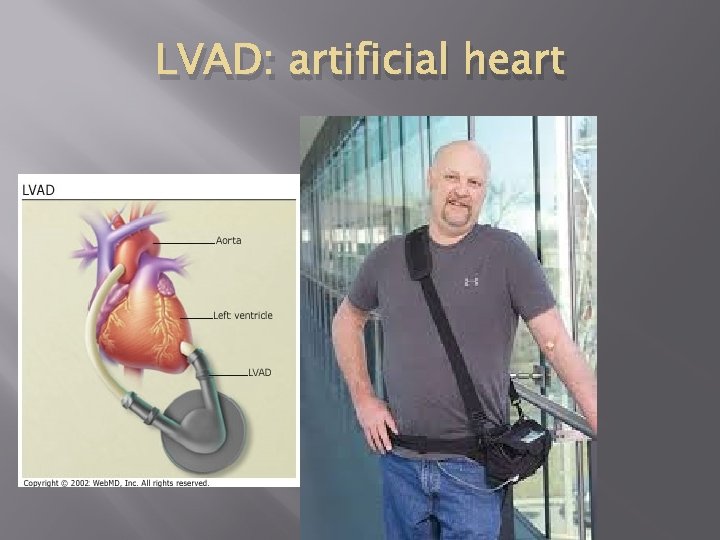 LVAD: artificial heart 