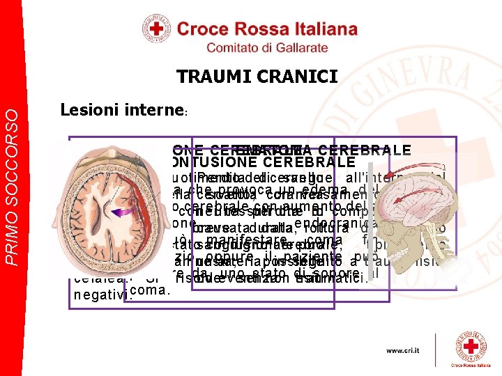 PRIMO SOCCORSO TRAUMI CRANICI Lesioni interne: COMMOZIONE CEREBRALE EMATOMA CEREBRALE CONTUSIONE CEREBRALE Dovuta allo