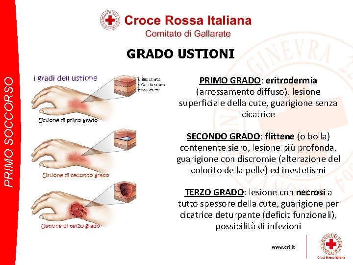 PRIMO SOCCORSO GRADO USTIONI PRIMO GRADO: eritrodermia (arrossamento diffuso), lesione superficiale della cute, guarigione