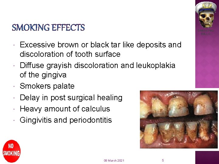 SMOKING EFFECTS Excessive brown or black tar like deposits and discoloration of tooth surface