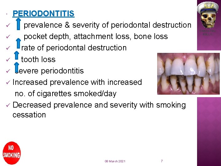 PERIODONTITIS ü prevalence & severity of periodontal destruction ü pocket depth, attachment loss, bone