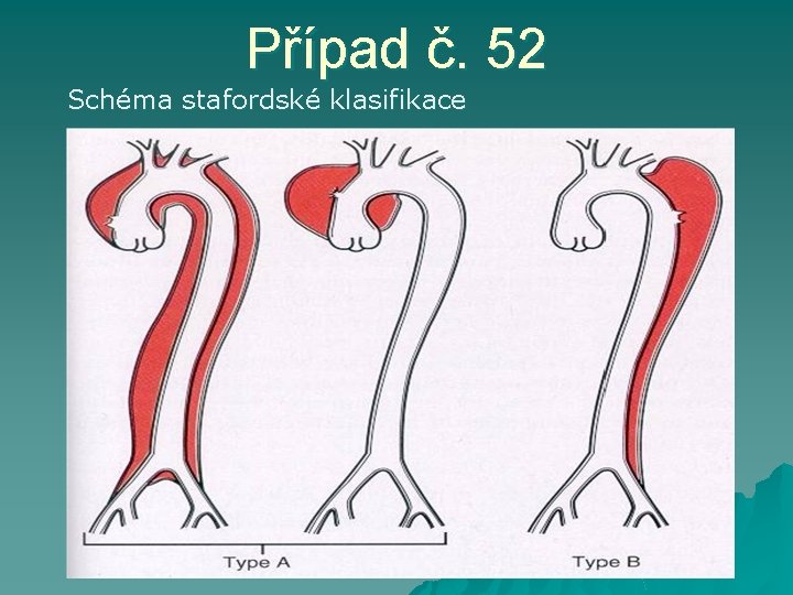 Případ č. 52 Schéma stafordské klasifikace 