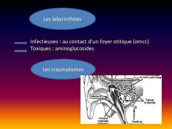 Les labyrinthites Infectieuses : au contact d’un foyer otitique (omcc) Toxiques : aminoglucosides Les Les labyrinthites Infectieuses : au contact d’un foyer otitique (omcc) Toxiques : aminoglucosides Les