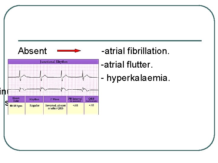 Absent inus arrest and sinoatrial block. -atrial fibrillation. -atrial flutter. - hyperkalaemia. 