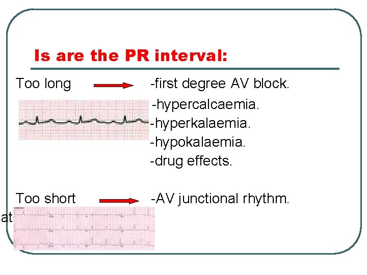 Is are the PR interval: Too long -first degree AV block. -hypercalcaemia. -hyperkalaemia. -hypokalaemia.