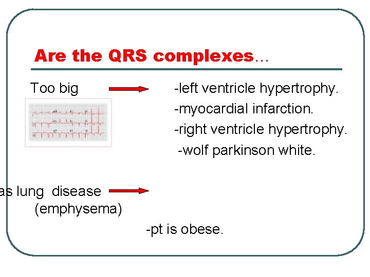 Are the QRS complexes… Too big -left ventricle hypertrophy. -myocardial infarction. -right ventricle hypertrophy.