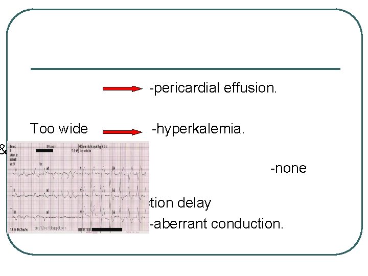-pericardial effusion. Too wide &right bundle branch block -hyperkalemia. -none ventricular conduction delay -aberrant