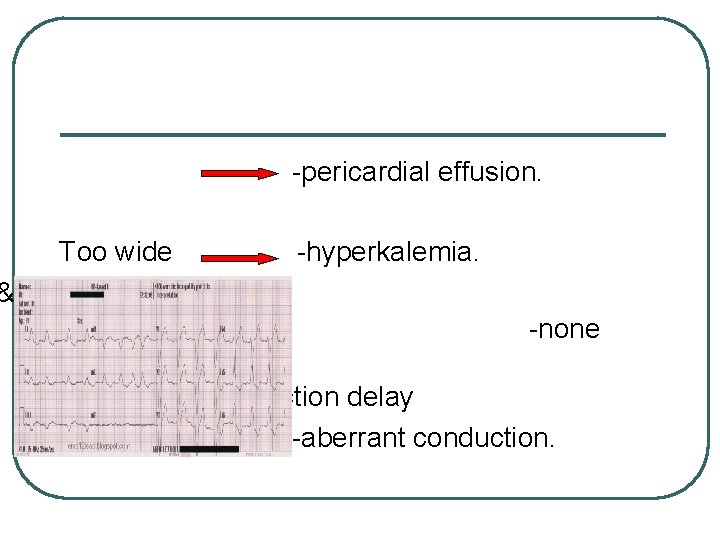 -pericardial effusion. Too wide &right bundle branch block -hyperkalemia. -none ventricular conduction delay -aberrant