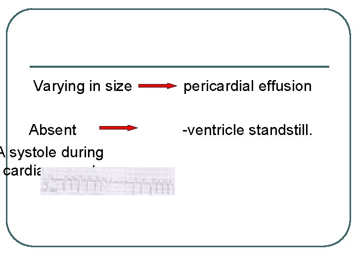 Varying in size Absent A systole during cardiac arrest pericardial effusion -ventricle standstill. 