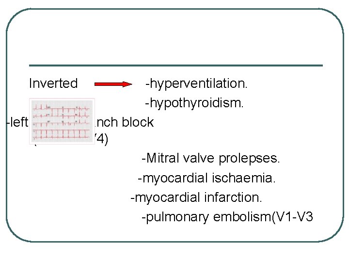Inverted -hyperventilation. -hypothyroidism. -left bundle branch block (lead V 1 -V 4) -Mitral valve