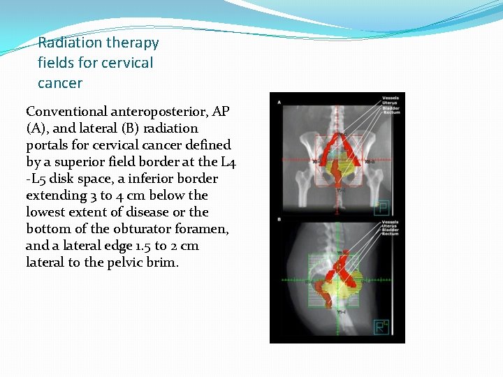 Radiation therapy fields for cervical cancer Conventional anteroposterior, AP (A), and lateral (B) radiation Radiation therapy fields for cervical cancer Conventional anteroposterior, AP (A), and lateral (B) radiation