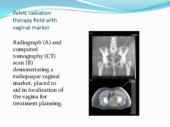 Pelvic radiation therapy field with vaginal marker Radiograph (A) and computed tomography (CT) scan Pelvic radiation therapy field with vaginal marker Radiograph (A) and computed tomography (CT) scan