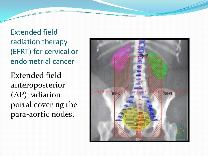 Extended field radiation therapy (EFRT) for cervical or endometrial cancer Extended field anteroposterior (AP) Extended field radiation therapy (EFRT) for cervical or endometrial cancer Extended field anteroposterior (AP)